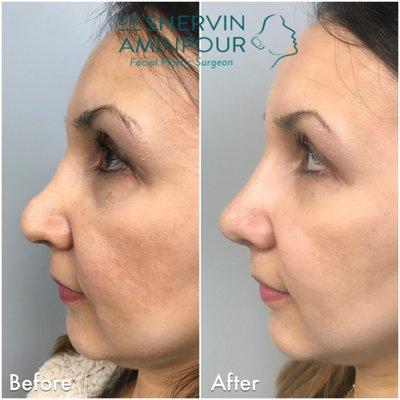 Dr. Aminpour plans and designs your nose from all angles. This patient came in for a revision of her first rhinoplasty by another doctor.