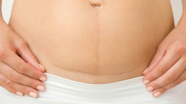 C-Section Scar Removing Massage