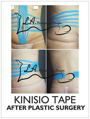 kinesio tape gently lifts the upper layers of skin, creating a negative pressure that encourages the removal of excess fluid .