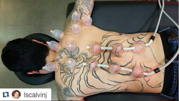 Cupping for neck / shoulder / lower back