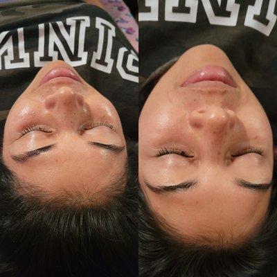 Before and after basic facial