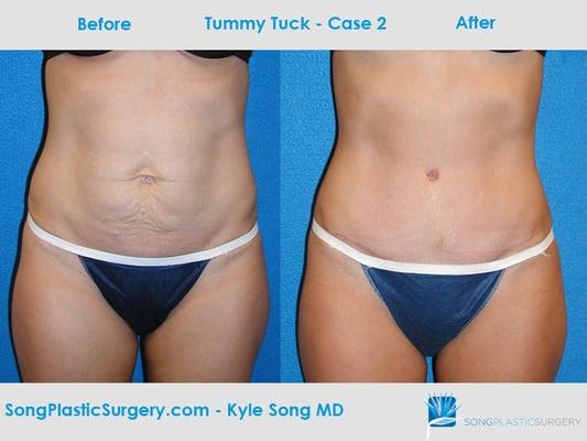 Tummy Tuck before & after: goal was to get rid of excess skin & lower abdomen bulge.