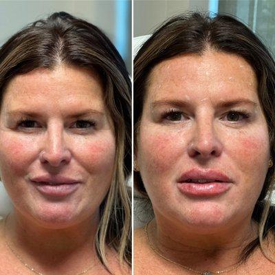 Before and after lip filler.