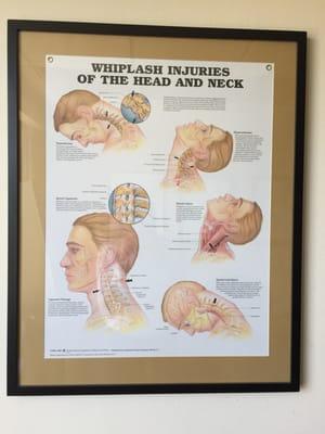 Whiplash Injuries of the Head and Neck