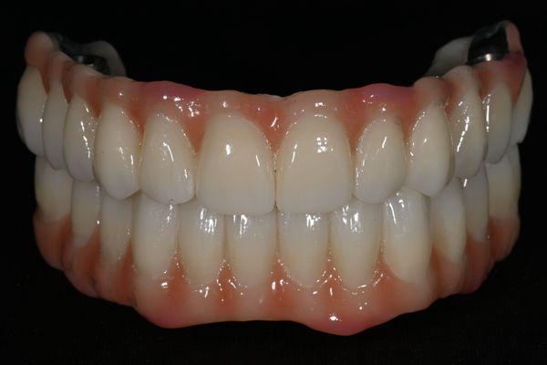 Implant supported dentures before placement