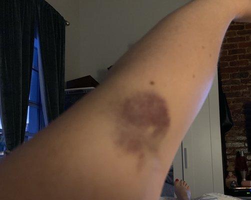 Bruising from where tech squeezed my arm to try to push blood out even though needle did not hit vein. Hurts!