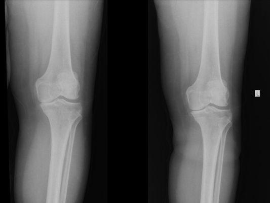 Left knee - NOT bone on bone! We help the body heal and grow. Call today to find out how!