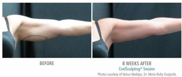 Say goodbye to bat wings with Coolsculpting!