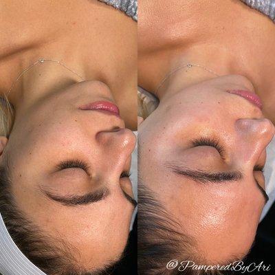 Hydrodermabrasion & Oxygen Therapy Before & After