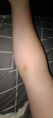 Bruised left over from the first attempt of the injection. She accidently infiltrated my arm.