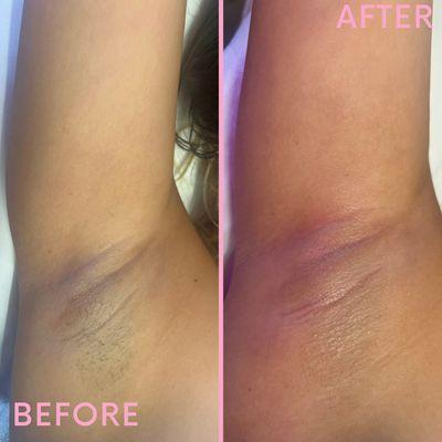 Underarm sugaring before & after