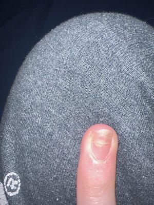 Injured nail