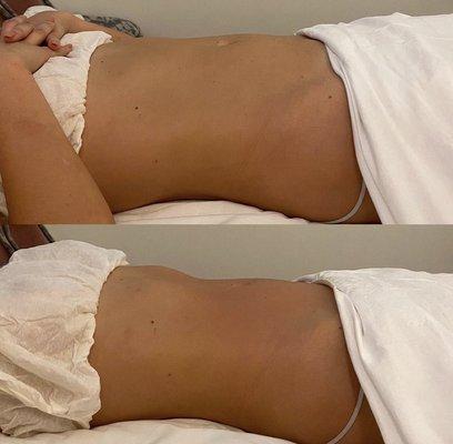 Before and after a lymphatic drainage massage session