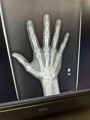 Fractured hand