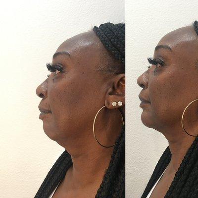 Chin and mid face augmentation