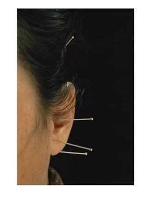 Acupuncture can have profound effects.