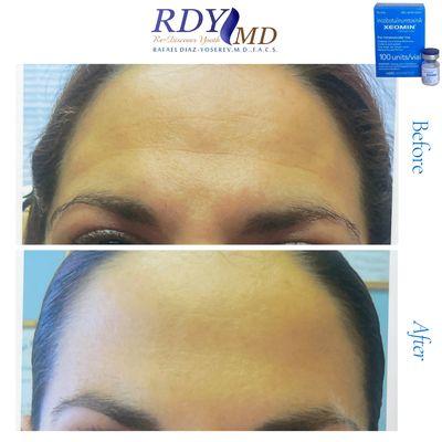 Xeomin / Botox / botulinum
Toxin a / dysport / daxify