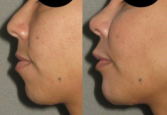 Non Surgical Nose and Chin Treatment