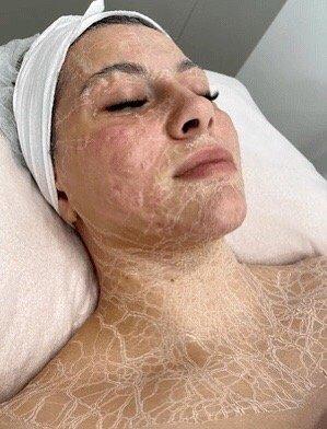 DMK for acne & acne scars / rosacea/ anti aging / wrinkles