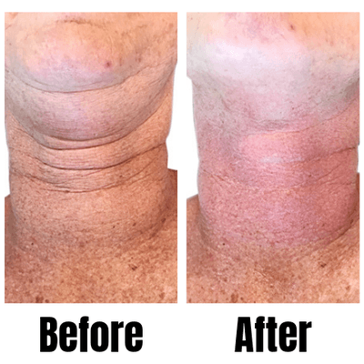 Anti-aging treatment on the neck.