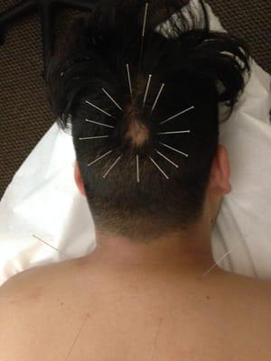 Treatment for Alopecia