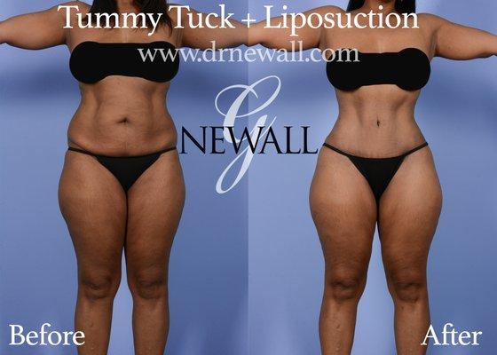 Dr. Newall Tummy Tuck