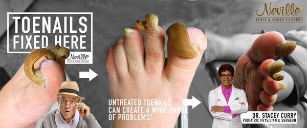 Taking care of your toenails can prevent pain in mobility. This is an extreme case, but even slightly elongated toenails can create problems