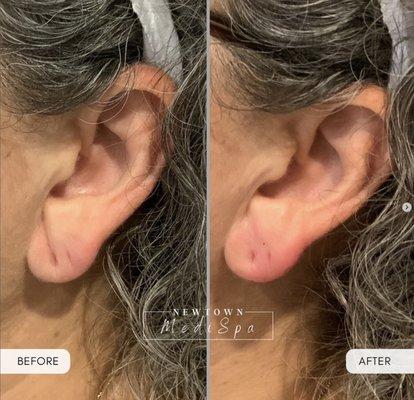 Earlobe Filler for the win!