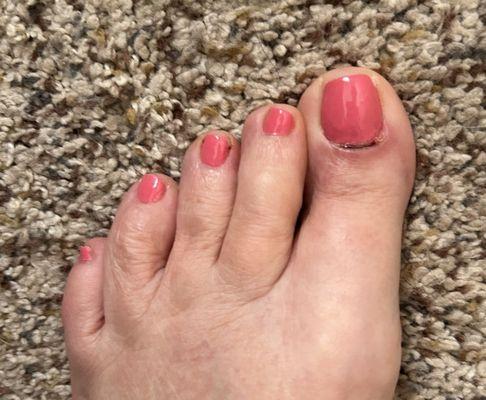 Results of rough treatment on big toe during manicure