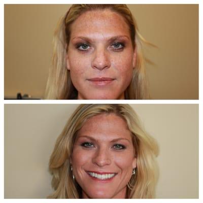 Full face before & after