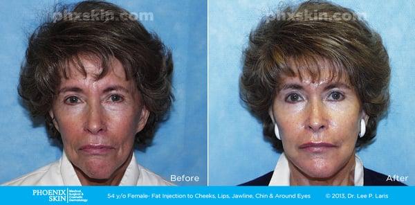 Fat injection to the cheeks, lips, jawline, chin and around eyes to volumize.