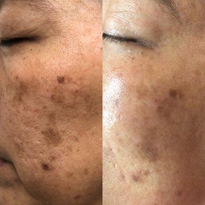 After 2 Light Laser Peels