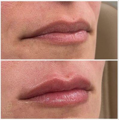 Lip filler using Numa's advanced microcannula technique