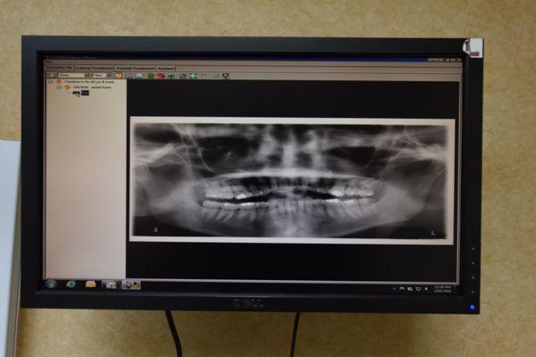 3/16/18 - My lower left wisdom tooth was chipped. My Dentist referred me to Dr. Spoolstra for double left wisdom teeth extractions.