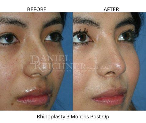 Rhinoplasty Before & After 3 Months Post Op