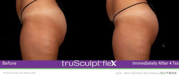 Body Contouring- revolutionary non surgical treatments