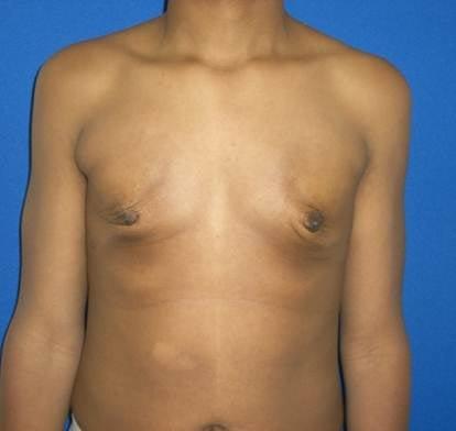 Gynecomastia After