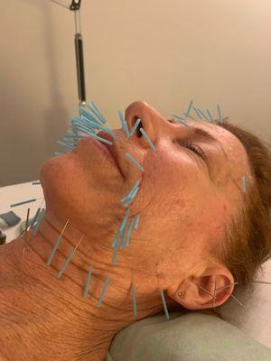 Facial Acupuncture for the jowls and marionettes