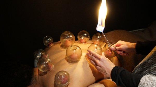 Fire Cupping