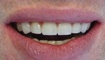 Worn Teeth After