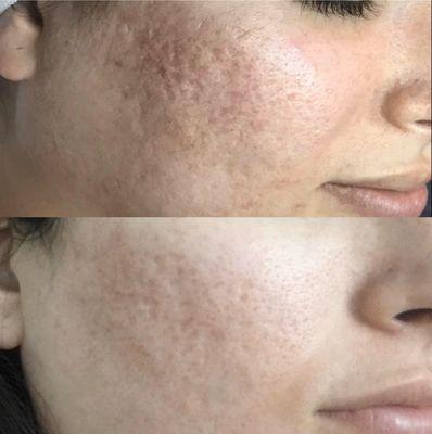 Amazing before/after with one micro channeling treatment. Photos taken 4 weeks apart