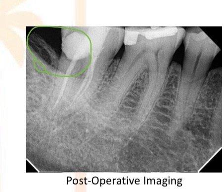 Bone/gum structure surrounding my tooth after the treatment