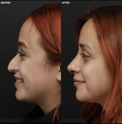 Rhinoplasty