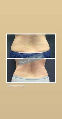 Coolsculpting to flanks!