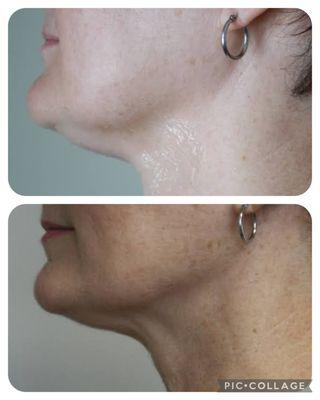 Kybella: Before & After