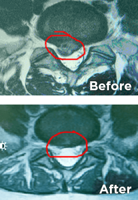 When to use non surgical spinal decompression and adjunctive therapies.