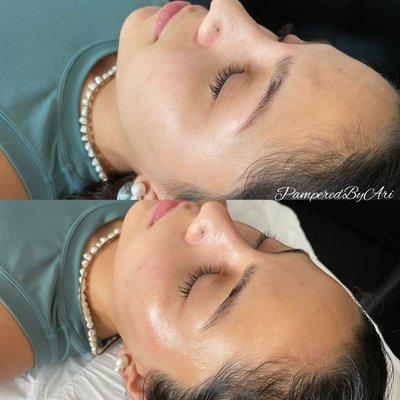 Dermaplaning Before & After