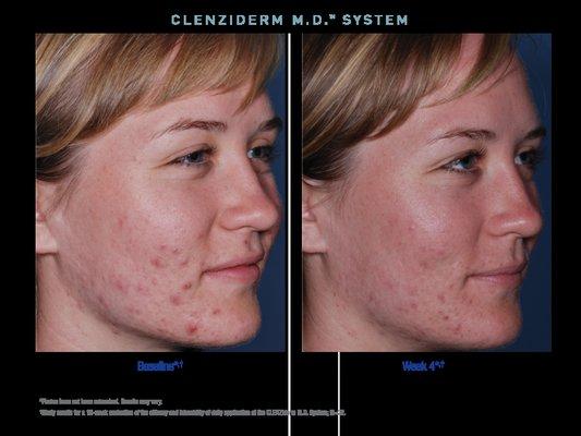 Clear up adult acne: http://www.enhancedform.com/2018/02/23/prone-adult-acne/