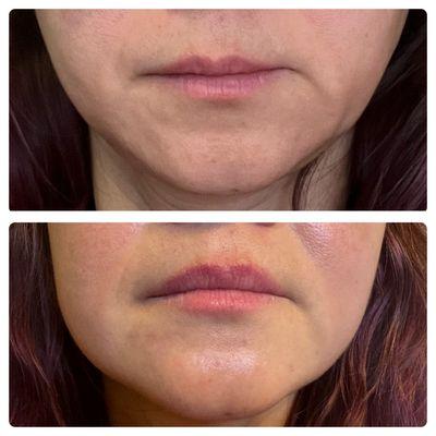 Hydrafacial and RF contouring on the jaw line