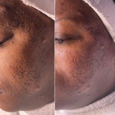 Micro needling Treatment reducing acne scaring & refining texture